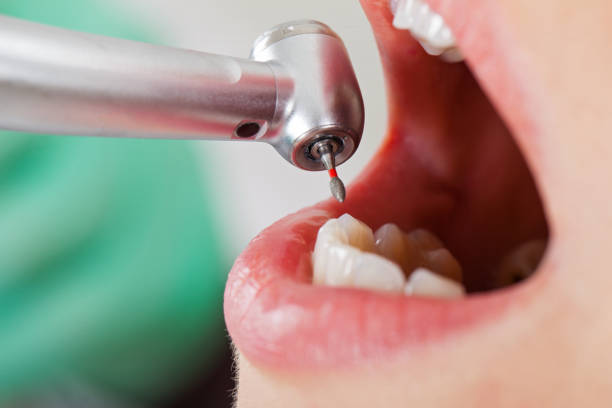 Best Emergency Dental Surgery in Morgan Hill, CA